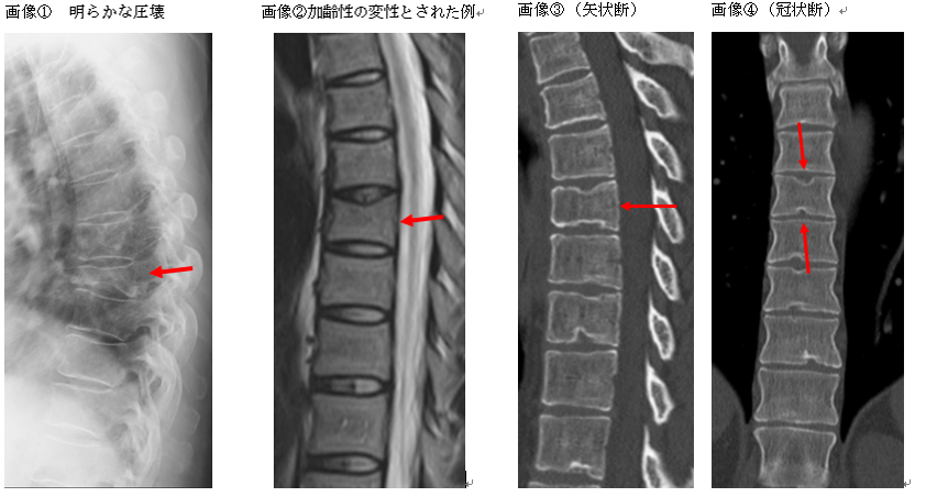 骨折による後遺障害（脊椎圧迫骨折、CRPS） | 【公式】名古屋 交通事故 